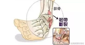 韌帶提拉手術(shù)后的注意事項(xiàng)