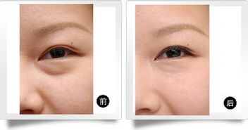 眼部抽脂術(shù)后注意事項