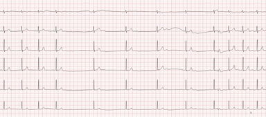 尿檢,心電圖,注意事項(xiàng)