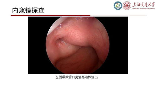 腦脊液耳漏注意事項,頭部外傷注意事項,頭部ct注意事項