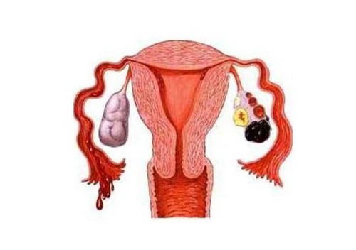 巧克力囊腫術(shù)后飲食注意事項(xiàng)