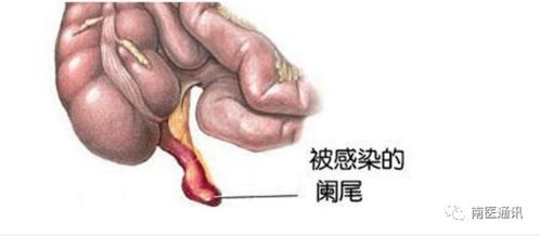 闌尾炎,切除,注意事項,飲食