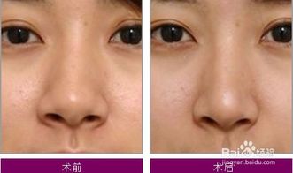 整容,術(shù)前,注意事項