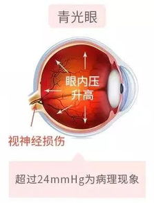 青光眼的日常注意事項(xiàng),青光眼注意事項(xiàng)和飲食,青光眼術(shù)后3月注意事項(xiàng)