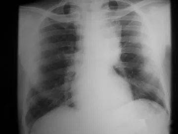 胸腺癌飲食注意事項,胸腺癌術后注意事項,胸腺癌放化療效果好嗎