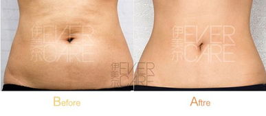 腰部吸脂術(shù)后注意事項(xiàng)