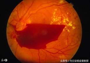 眼底水腫要注意事項(xiàng)