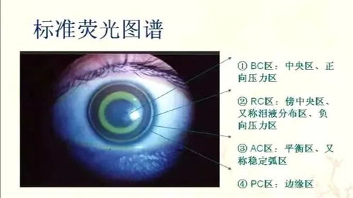 帶角膜塑形鏡注意事項