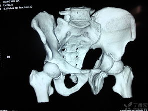 髖關(guān)節(jié)復(fù)位后注意事項,頸椎復(fù)位后的注意事項,腰復(fù)位后需要注意事項