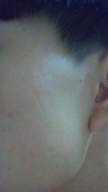 臉上點(diǎn)痣注意事項(xiàng),臉上激光祛斑注意事項(xiàng),孩子臉上縫針注意事項(xiàng)