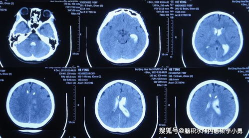 腦引流術(shù)后注意事項(xiàng)