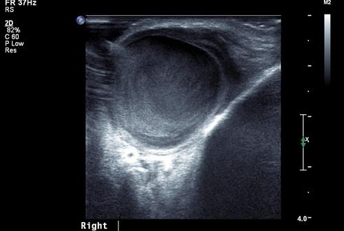 動(dòng)靜脈瘺護(hù)理注意事項(xiàng)PPT,子宮動(dòng)靜脈瘺護(hù)理注意事項(xiàng),動(dòng)靜脈瘺術(shù)后護(hù)理注意事項(xiàng)