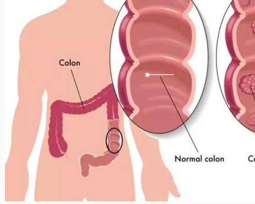 做腸息肉術(shù)后注意事項