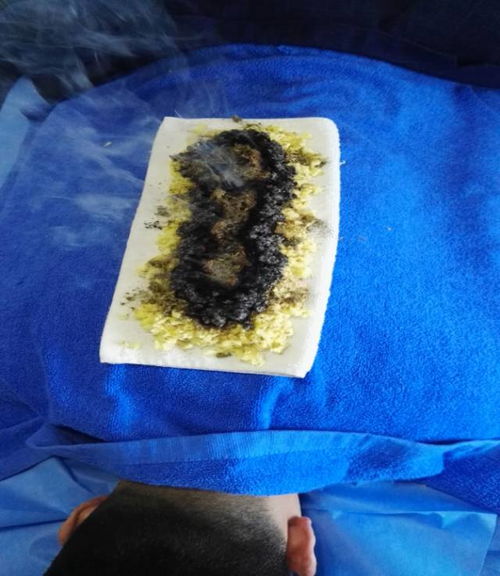 注意事項,長蛇灸