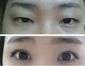 做完雙眼皮的注意事項(xiàng)