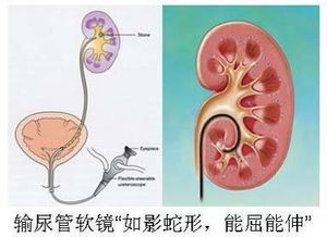 輸尿管軟鏡術(shù)后注意事項