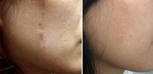 做完疤痕激光注意事項(xiàng)