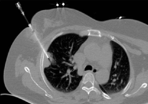 做肺部穿刺需注意事項(xiàng)