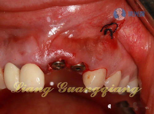 牙植骨后注意事項(xiàng),牙槽植骨術(shù)后注意事項(xiàng),種牙植骨拆線后注意事項(xiàng)