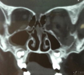 鼻漏修補(bǔ)后注意事項(xiàng),腦脊液漏注意事項(xiàng),漏尿注意事項(xiàng)