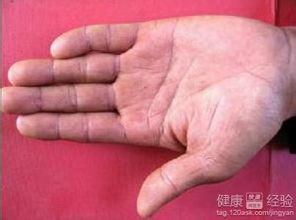 皮下結(jié)節(jié)注意事項