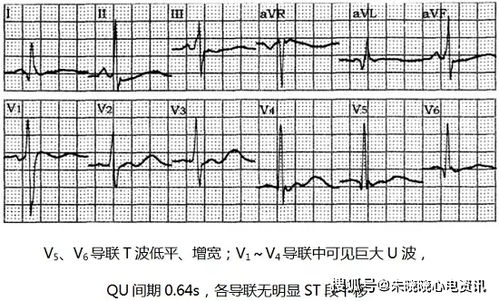 孕婦低鉀血癥注意事項(xiàng)