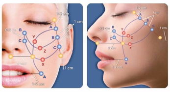 韓國(guó)蛋白螺旋線埋入后注意事項(xiàng)
