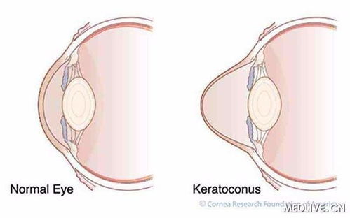 角膜,圓錐,注意事項