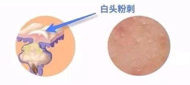 粉刺清理后注意事項