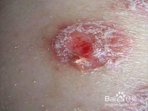 銀屑病治療方案及注意事項,銀屑病關節(jié)炎注意事項,銀屑病平時注意事項