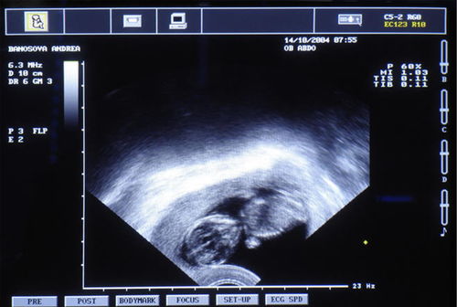 陰式彩超檢查注意事項(xiàng)