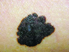 注意事項(xiàng),患者,黑色素瘤