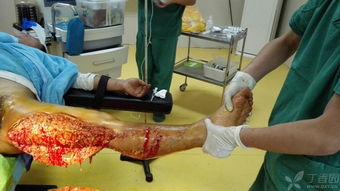 自體植皮注意事項