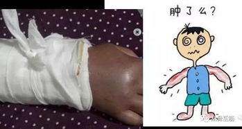 石膏拆掉后的注意事項(xiàng)