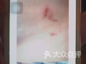 注意事項(xiàng),減肥,拔罐