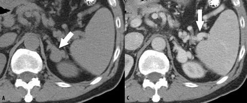 腎上腺avs后注意事項(xiàng)
