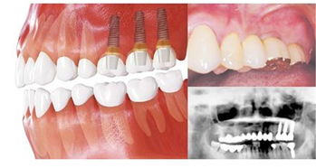 剛種牙后注意事項(xiàng)