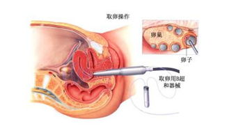 試管嬰兒取卵前后的注意事項(xiàng),試管嬰兒取卵術(shù)后注意事項(xiàng),試管嬰兒取卵注意事項(xiàng)及經(jīng)驗(yàn)