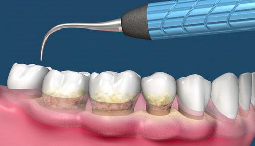 牙結(jié)石洗牙后注意事項有哪些