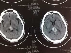 松果體,鈣化,注意事項(xiàng)