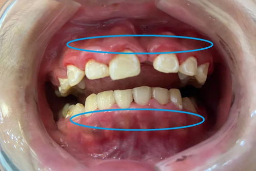 齦下刮治注意事項(xiàng)