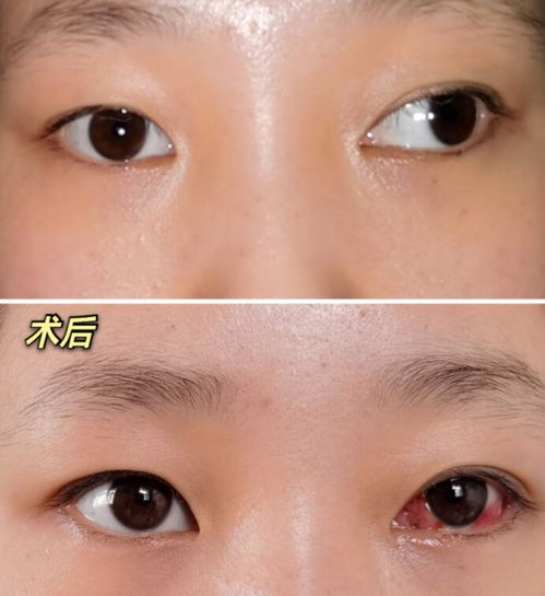 斜視手術(shù)前注意事項