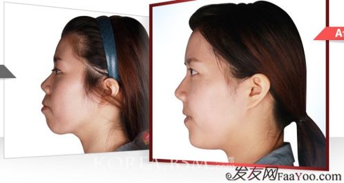 做完嘴巴整形的注意事項(xiàng),整容注意事項(xiàng)容注意事項(xiàng),整容合同注意事項(xiàng)