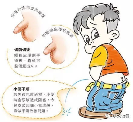 割包皮兒童注意事項(xiàng)
