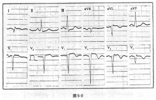 注意事項,前壁心梗后