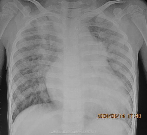 幼兒拍胸片注意事項,兒童拍胸片的注意事項,女性拍胸片注意事項