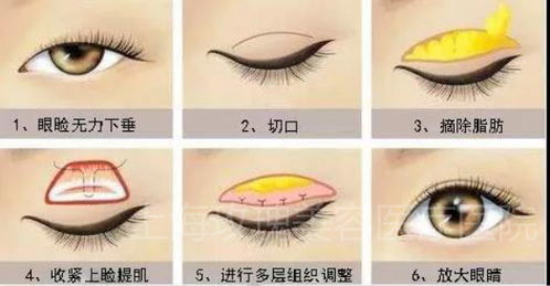 換眼睛手術(shù)后注意事項(xiàng)