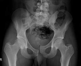 骶椎骨折注意事項,骶椎骨折恢復(fù)注意事項,女性尾椎骨折注意事項