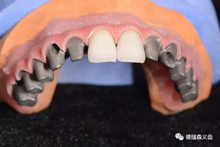 牙疼的飲食和注意事項,上火牙疼注意事項,牙疼期間注意事項