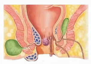 確診,肛瘺,注意事項